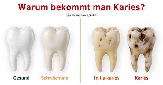 Warum bekommt man Karies? Die wahren Ursachen erklärt